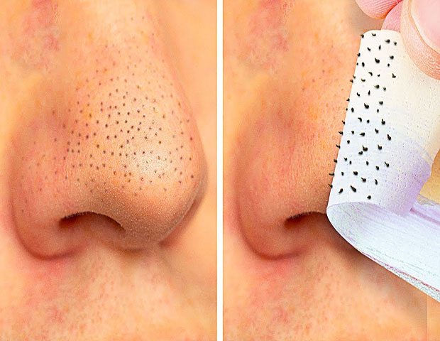 Siyah nokta temizliği